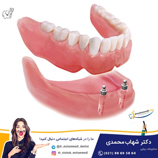اوردنچر (Overdenture) برپایه ایمپلنت - کلینیک دندانپزشکی دکتر شهاب محمدی